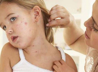 AN OUTBREAK OF SMALLPOX IN VRANJE AS WELL?