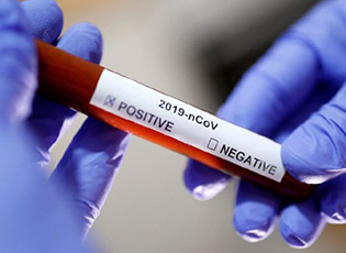 136 NEWLY INFECTED PERSONS WITH THE CORONA VIRUS IN THE PCINJ DISTRICT